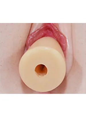 Removable